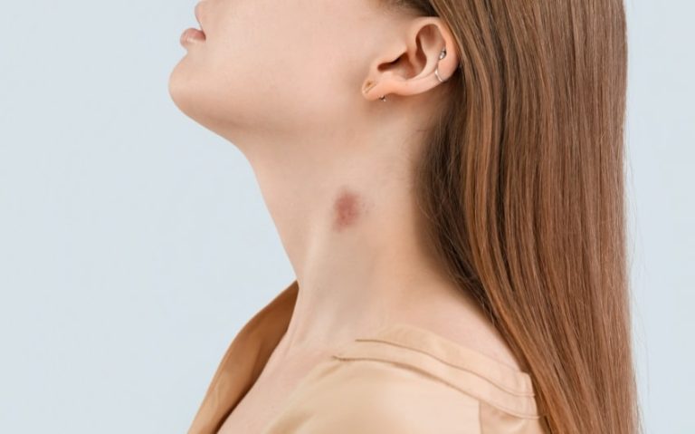 The Allure of the Love Bite: How to Give Yourself a Hickey